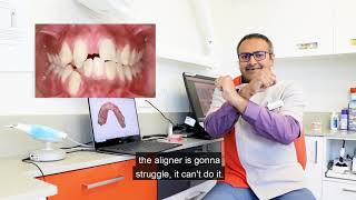 Who is not suitable for clear aligners [upl. by Ogden]