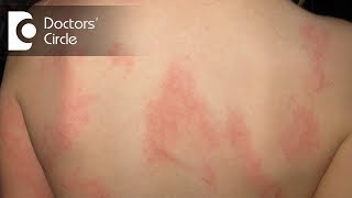 What happens in Hives and Angioedema  Dr Nischal K [upl. by Arrat]