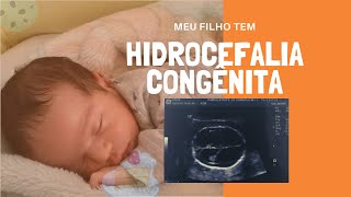 Meu filho com hidrocefalia [upl. by Enyad]