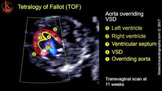 Fetal echocardiography at 1113 weeks Tetralogy of Fallot TOF [upl. by Aldous]