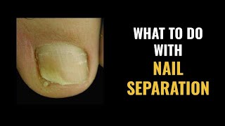 NAIL SEPARATION  What to DO and What are the CAUSES [upl. by Boccaj]