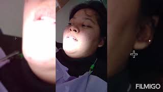 Local anesthesia and tooth extraction of upper radix first molar [upl. by Akim]