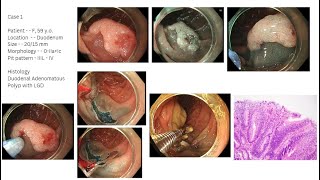 ESD and EMR of Lesion of GI Tract  Todua Clinic [upl. by Adieno]