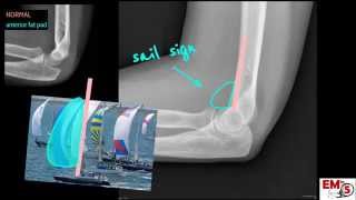 Elbow Xray Interpretation [upl. by Maddis25]