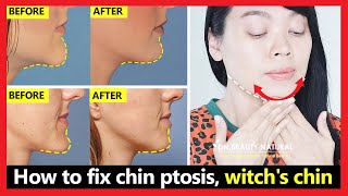 How to fix chin ptosis witchs chin chin correction chin long get beautiful chin without surgery [upl. by Yehs]