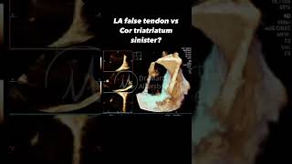 TEE amp the left atrium  LA false tendon vs incomplete cor triatriatum sinister [upl. by Ledoux]