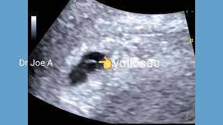 Early intrauterine pregnancy confirmation by yolk sac on transvaginal scan ultrasound video [upl. by Enaffit]