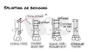 Principles of Fracture Fixation  Orthopedic Basics [upl. by Nasaj211]