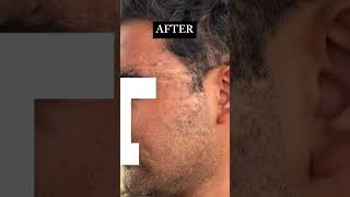 Scar resurfacing after one session of erbium yag laser and threads 8957132986 lucknow [upl. by Anilef]