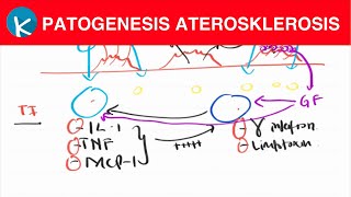 Patogenesis Aterosklerosis  Proses Terbentuknya Plak Aterosklerosis [upl. by Bock452]