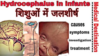 Hydrocephalus in infantscausessymptomtreatment and prevention in hindi  Medical destination [upl. by Airakaz243]