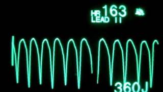 Pulseless Ventricular Tachycardia pVT  Monophasic Defibrillation at 360 Joules [upl. by Llerej]