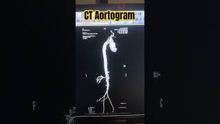 Ct Aortogram  Angioof Aorta medicos1k86 radiology ct anatomy neet trendingshortsviralxray [upl. by Drucill]