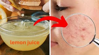 How to get rid of acne scars at home [upl. by Feeley4]