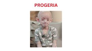 PROGERIA A MEDICAL MYSTERY OF AGING [upl. by Darra]