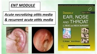 ENT Acute necrotizing amp recurrent otitis mediaear otitismedia ent [upl. by Leizahaj781]