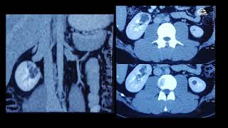 PETCT in testicular cancer [upl. by Alda908]