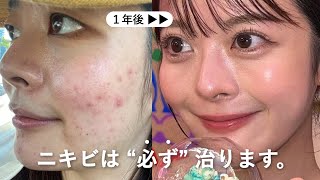 本気で治したい人だけ見て。ニキビ地獄から､毛穴ゼロ＆たまご肌になった5つの方法🥚 [upl. by Ajna]