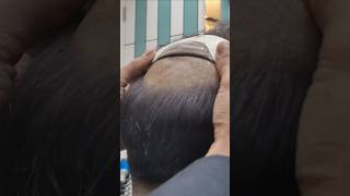 Permanent hair patch delhi  Best hair patch for mens hairfixing hairtutorial [upl. by Reiniar]