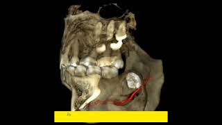 Cyst enucleation [upl. by Kraul]