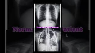 Xray 🩻 of chest PA view normal patient ampTB patient motivational nursing medicalknowlege [upl. by Casaleggio723]