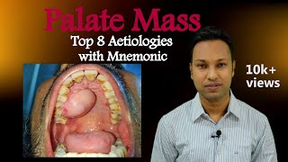 Palate Mass Top 8 Aetiologies with Picture and Mnemonic [upl. by Sorkin]