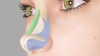 Saddle Nose or Ski Slope Nose Rhinoplasty Nosejob [upl. by Nivat756]