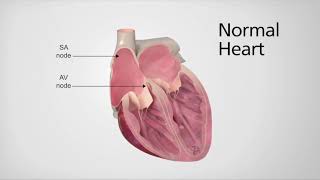 Normal Heart vs Heart in AFib [upl. by Wrench]