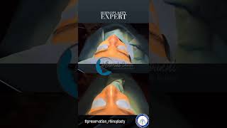 Rhinoplastie ultrasonique au bloc preservationrhinoplasty rhinoexpert [upl. by Ahsel227]