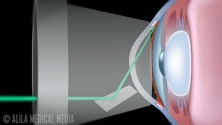 Laser Trabeculoplasty for Glaucoma ALT vs SLT Animation [upl. by Davy]