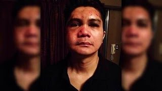 Vhong Navarro bugbog sarado sa mga kuhang larawan [upl. by Jecoa342]