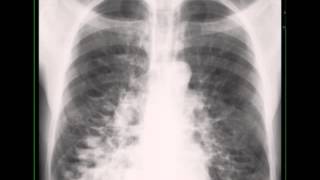 Cystic Bronchiectasis on Chest X ray [upl. by Bennett]