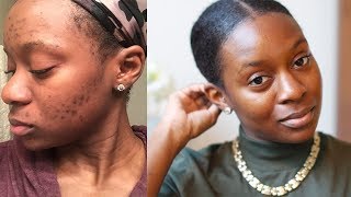 The best Hyperpigmentation Treatment for Black Skin [upl. by Thekla]