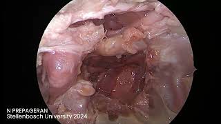 Module 10 Endoscopic Transclival approach and review of anatomy [upl. by Eiraminot]