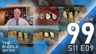 S11 E09  Restoring EndodonticallyTreated Teeth Special Presentation by Dr Gordon Christensen [upl. by Ahseneuq638]