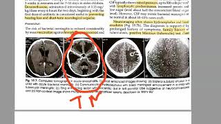 Pediatrics 569 Tuberculous meningitis Rich foci HYDROCEPHALUS Tuberculosis child [upl. by Brodsky]