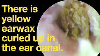 There is yellow earwax curled up in the ear canalear wax removal  ear cleaning  ASMR  relax [upl. by Rezeile]