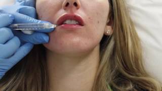 Juvederm lip filler injection by Dr Shaun Patel in Miami Florida [upl. by Meador724]