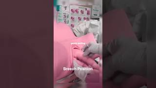 Breech Position mbbs hospital comedyvideos trending MRAnsari7987 [upl. by Anitnauq]