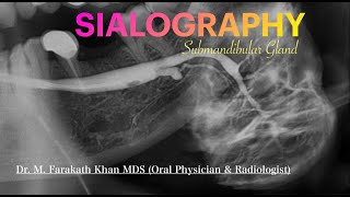 SIALOGRAPHY of submandibular gland [upl. by Eisinger458]