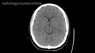 What is cavum veli interpositi cyst [upl. by Nahoj]