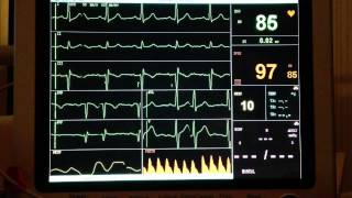 ECG  Extrasystole [upl. by Eiliah]