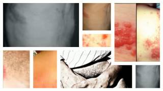 Other Symptoms Of Shingles Rash [upl. by Rubenstein873]