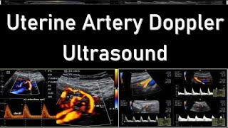 Uterine Artery Doppler Ultrasound Interpretation  Doppler Ultrasound in Fetal Growth Assessment [upl. by Noramac377]