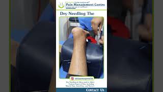 Dry Needling Therapy [upl. by Aural]