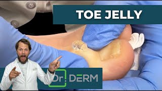 Toe Jelly Cyst  Dr Derm [upl. by Akehsat]