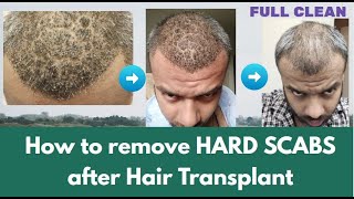 How to remove Hard Scabs after Hair Transplant  KV Hair Care amp Life [upl. by Enilesor]