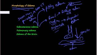 45Morphology of Edema Subcutaneous edema Pulmonary edema Edema of the brain [upl. by Cesar]