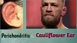 Perichondritis amp Cauliflower Ear  ENT Lecture [upl. by Kacerek]