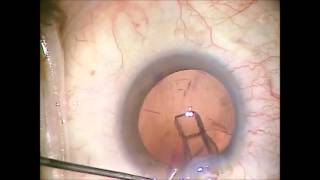 Trulign Lens Implant from BauschLomb by Jeffrey Whitman MD [upl. by Ahsirahc]